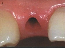 одноэтапная имплантация одного зуба